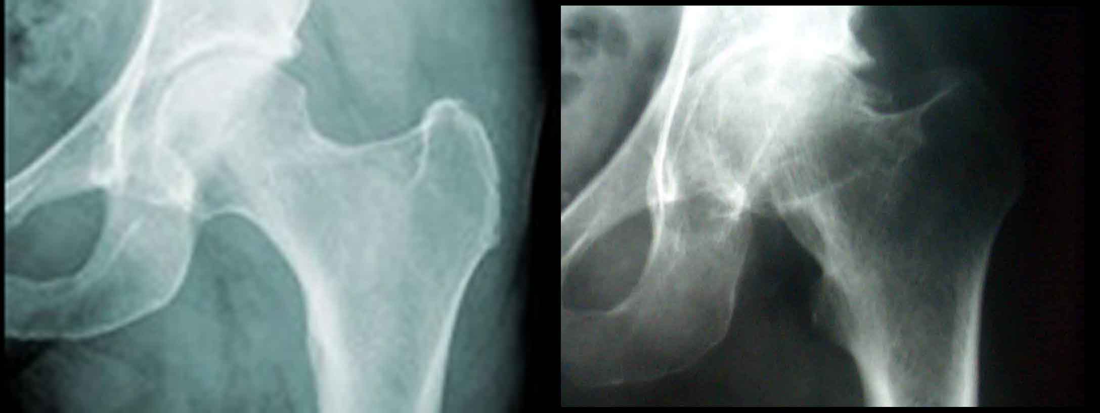 Radiografie di confronto tra anca sana e con artrosi